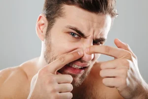 4 Bahan Alami yang Dapat Membantu Mengatasi Jerawat di Area Hidung dengan Cepat