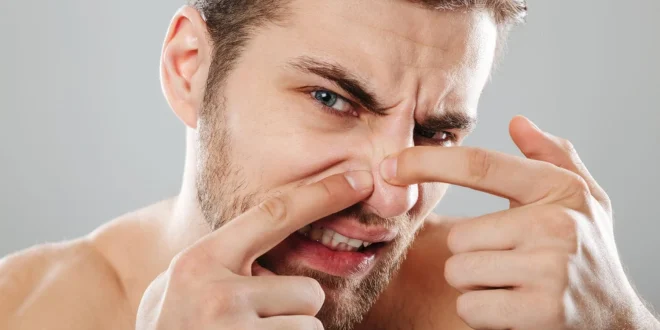 4 Bahan Alami yang Dapat Membantu Mengatasi Jerawat di Area Hidung dengan Cepat