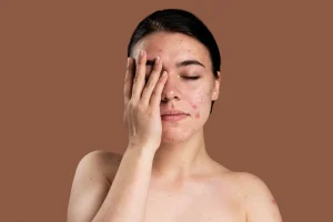 5 Khasiat Lidah Buaya untuk Kulit Wajah, Salah Satunya Kurangi Kemerahan Akibat Jerawat