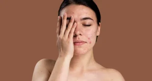 5 Khasiat Lidah Buaya untuk Kulit Wajah, Salah Satunya Kurangi Kemerahan Akibat Jerawat