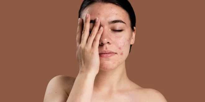 5 Khasiat Lidah Buaya untuk Kulit Wajah, Salah Satunya Kurangi Kemerahan Akibat Jerawat