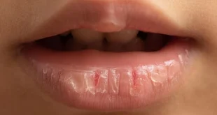 Bibir Kering dan Pecah-Pecah Coba 7 Cara Sederhana untuk Membantu Memulihkannya
