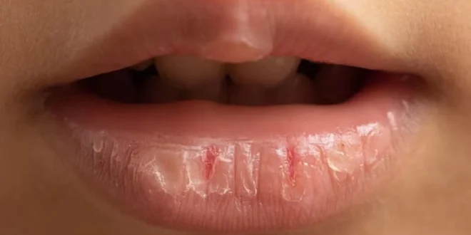 Bibir Kering dan Pecah-Pecah Coba 7 Cara Sederhana untuk Membantu Memulihkannya