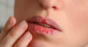Cara Alami Melembapkan Bibir Pecah-Pecah Tanpa Biaya Besar, Tak Perlu Produk Mahal Ini 5 Cara Alami Melembapkan Bibir Pecah-pecah