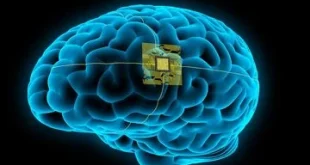 China Tanam Chip Otak Komersial Pertama di Dunia, Membuka Era Baru dalam Neuroteknologi