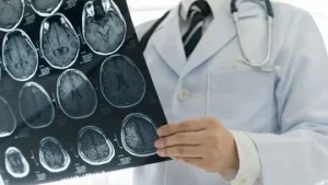 Golongan Darah A Membawa Risiko Tinggi Stroke di Usia Muda