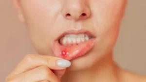 Makan Jadi Lancar dengan 5 Tips yang Ampuh Atasi Sariawan di Lidah