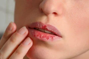 Tak Perlu Mahal Ini 5 Bahan Alami untuk Melembapkan Bibir Kering dengan Efektif