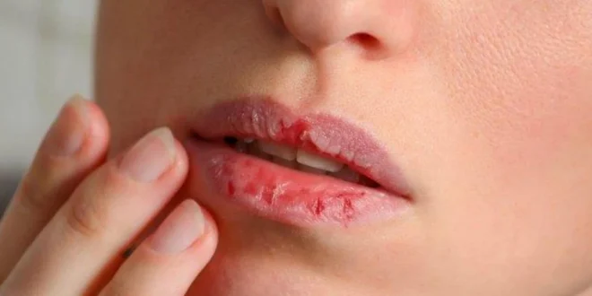 Tak Perlu Mahal Ini 5 Bahan Alami untuk Melembapkan Bibir Kering dengan Efektif