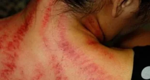 Benarkah Kerokan Sambil Tiduran Bisa Menyebabkan Kematian? Penelitian Ternyata Mengungkapkan Fakta Menarik!
