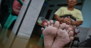 Mengatasi Kaki Gatal Terus? Kenali 5 Penyebab, Cara Mengatasi dan Mencegahnya