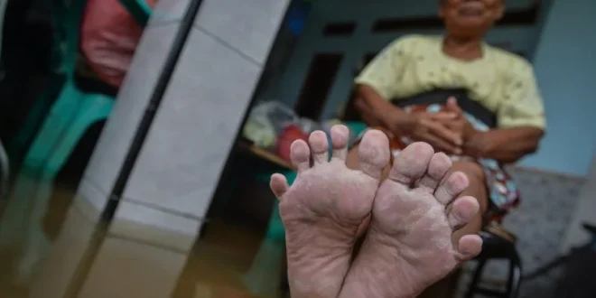 Mengatasi Kaki Gatal Terus? Kenali 5 Penyebab, Cara Mengatasi dan Mencegahnya