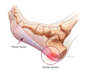 Mengenal Plantar Fasciitis Peradangan Jaringan yang Sebabkan Nyeri Hebat di Tumit