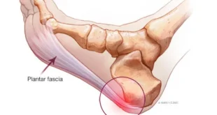 Mengenal Plantar Fasciitis Peradangan Jaringan yang Sebabkan Nyeri Hebat di Tumit