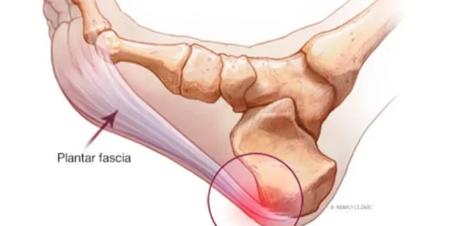 Mengenal Plantar Fasciitis Peradangan Jaringan yang Sebabkan Nyeri Hebat di Tumit