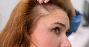 Tak Selalu karena Usia Ini Penyebab Rambut Menipis yang Perlu Diwaspadai