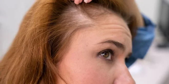 Tak Selalu karena Usia Ini Penyebab Rambut Menipis yang Perlu Diwaspadai